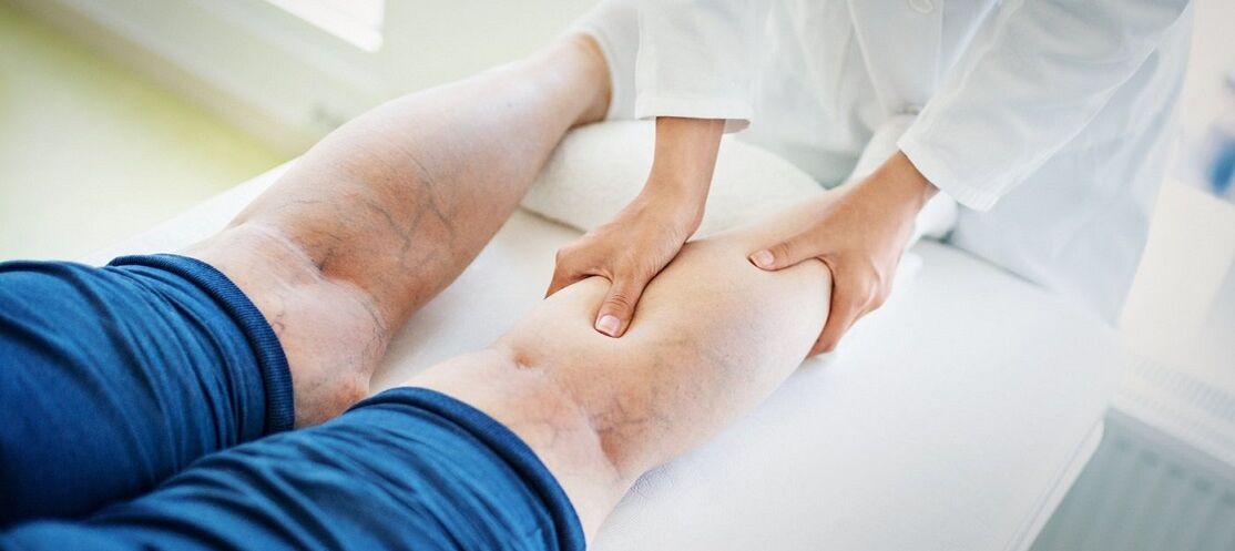 Varices sur les jambes et leur traitement